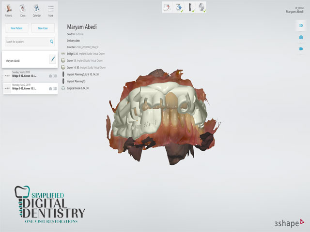 نرم افزار دندانپزشکی تری شیپ ایمپلنت استودیو (3Shape Implant Studio)