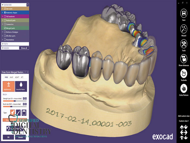 نرم افزار دندانپزشکی Exocad