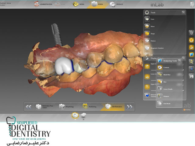 نرم افزار دندانپزشکی سیرونا (Sirona InLab )