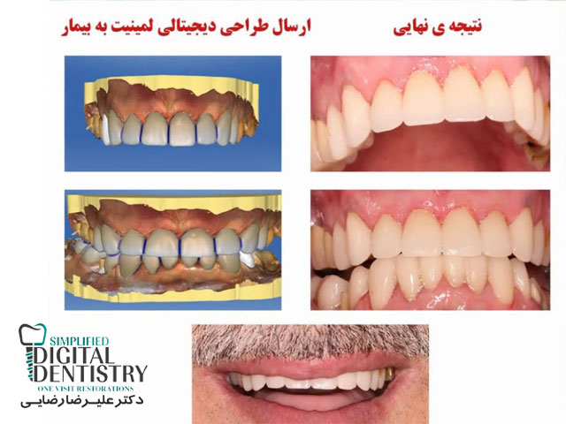 مرکز دندانپزشکی دیجیتال - طراحی دیجیتالی لمینیت