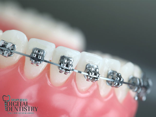 ارتودنسی به روش دیجیتال