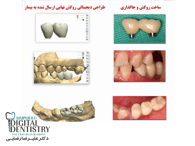 مرکز دندانپزشکی دیجیتال - طراحی دیجیتالی روکش نهایی ارسال شده به بیمار
