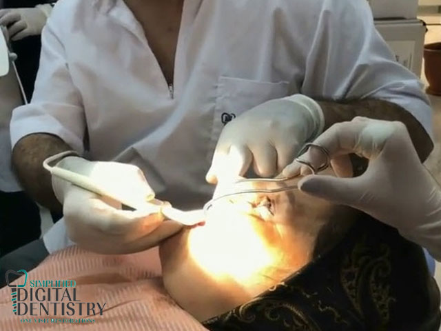 درمان یک جلسه ای دندان‎