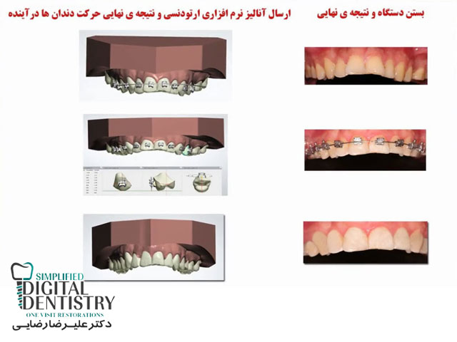 مرکز دندانپزشکی دیجیتال - ارسال آنالیز نرم افزاری ارتودنسی به بیمار