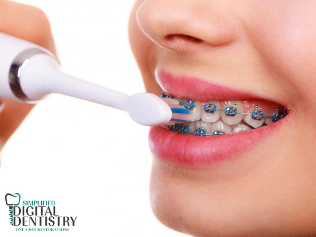 مراقبت های بعد از ارتودنسی