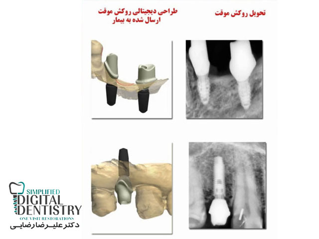 مرکز دندانپزشکی دیجیتال - طراحی دیجیتالی روکش موقت ارسال شده به بیمار