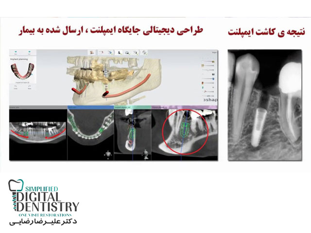 مرکز دندانپزشکی دیجیتال - طراحی دیجیتالی جایگاه ایمپلنت ، ارسال شده به بیمار