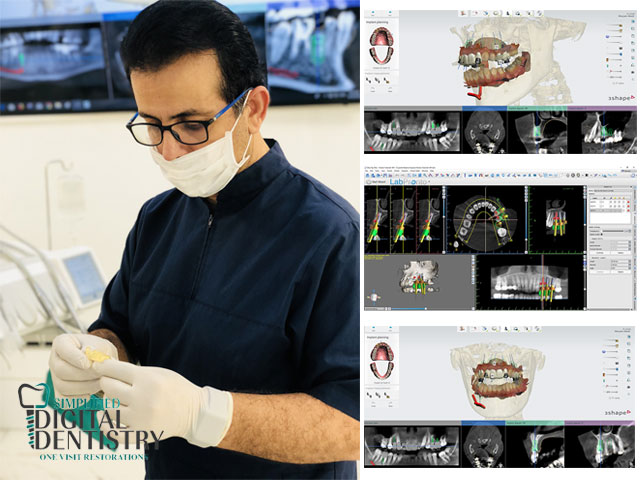ایمپلنت به روش دیجیتال