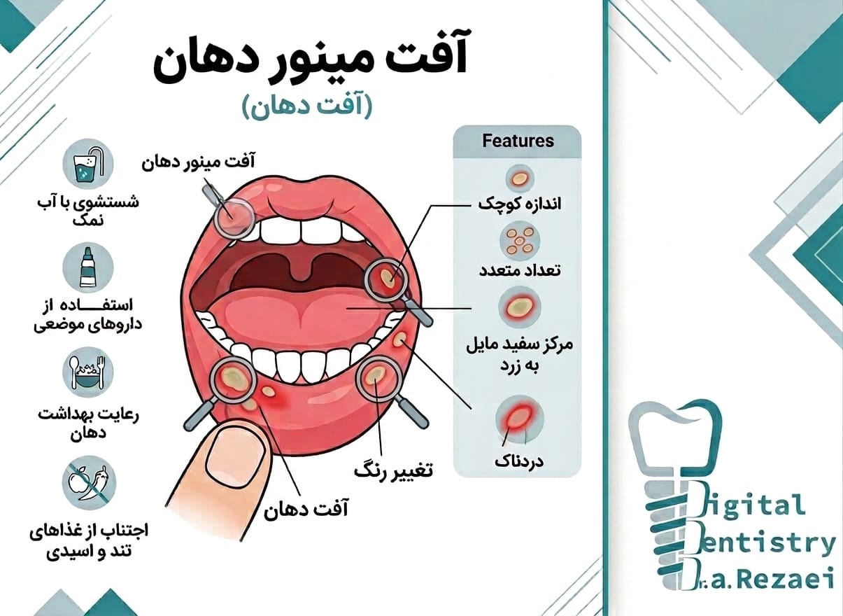 آفت دهان