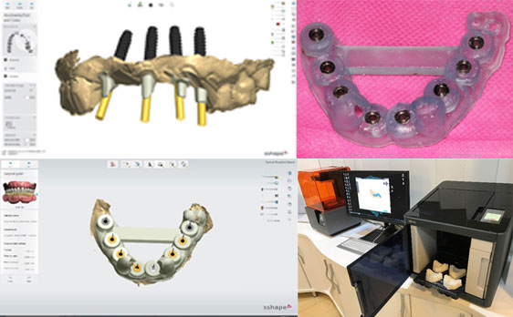 ایمپلنت دیجیتال دکتر علیرضا رضایی گاید جراحی