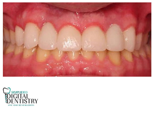 ایمپلنت دیجیتال و لمینیت دیجیتال