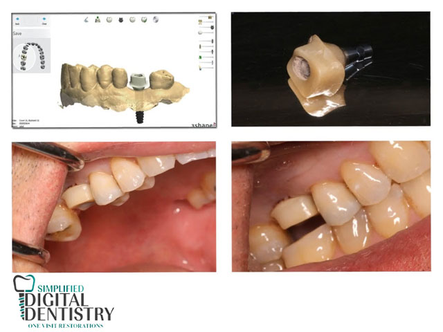 کاشت ایمپلنت به روش دیجیتال