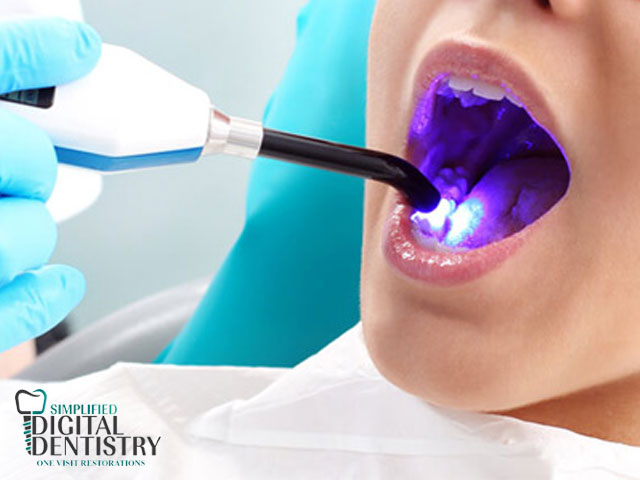 سفید کردن دندان با لیزر