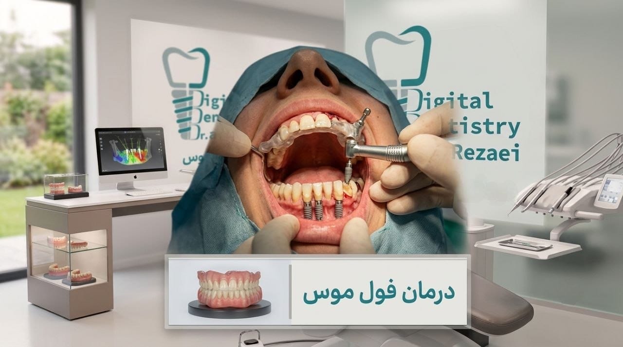 درمان فول ماوس full mouth در رشت