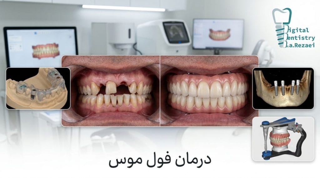 بازسازی کامل دندان ها
